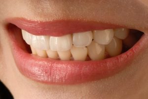 porcelain veneers treatment in hanford