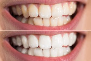 benefits of professional teeth whitening