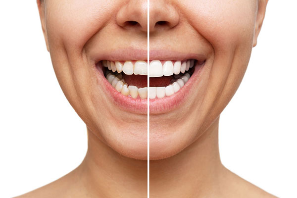 before and after porcelain veneers