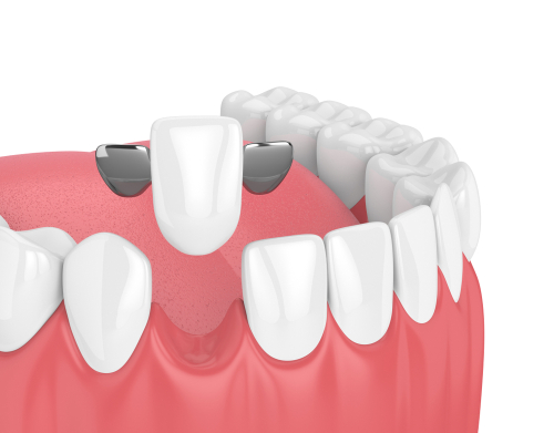 dental bridges