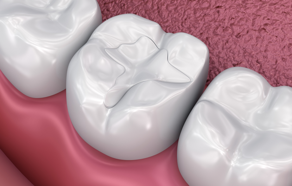 composite fillings