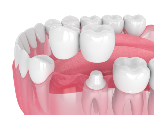 dental bridge